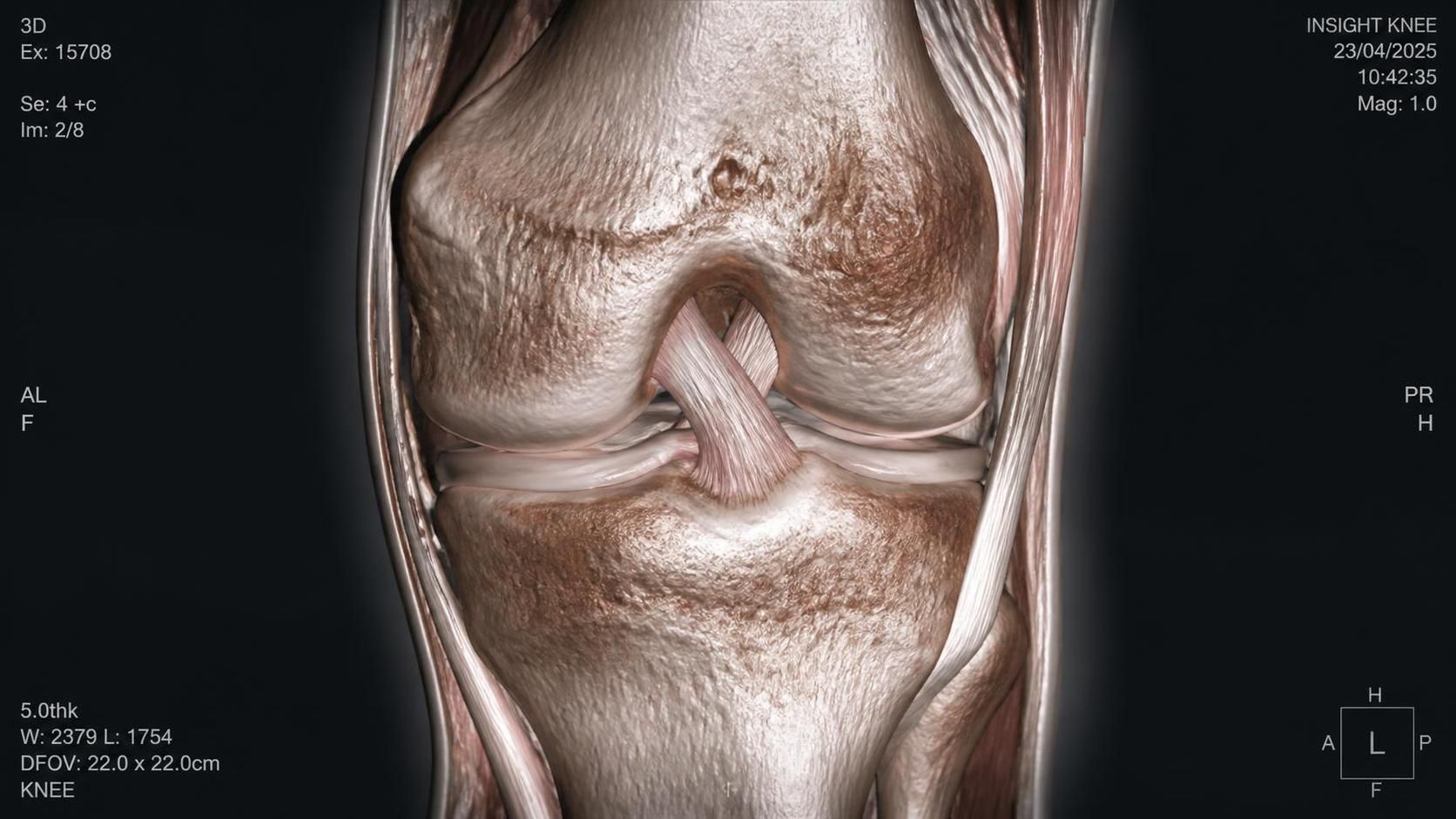 découvrez tout ce qu'il faut savoir sur la durée de récupération après une rupture des ligaments croisés du genou, les étapes clés et les conseils pour une guérison optimale.